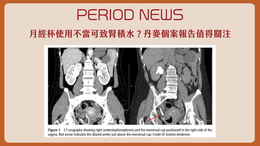 月經杯使用不當可致腎積水？丹麥個案報告值得關注